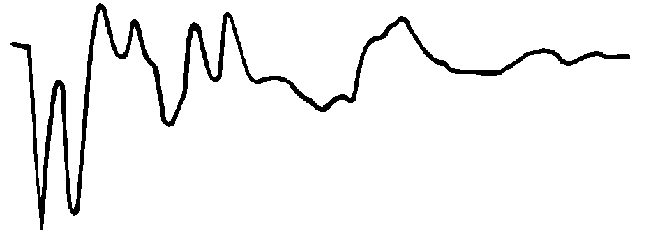 無(wú)遠端短路環(huán)波形